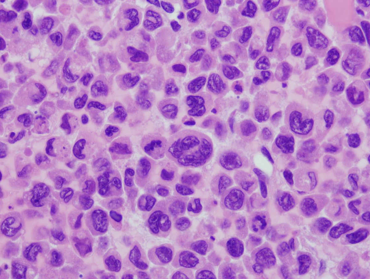 Figure 6. H&E stained section of the bone marrow biopsy extensively involved by AML.